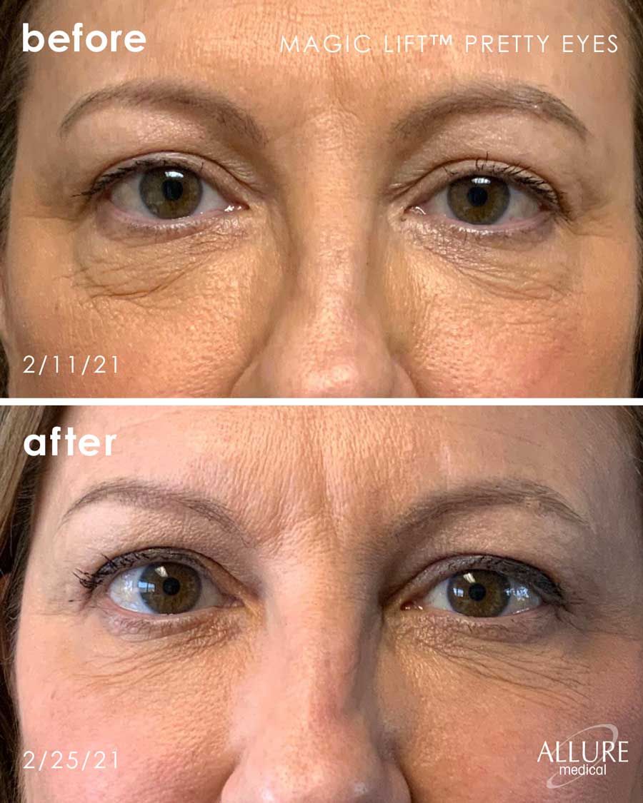 Before and After Magic Lift (Non-Surgical Face Lift) treatment #4