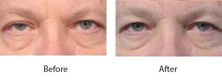 Before and After Cosmetic Eyelid Surgery treatment #3