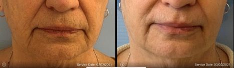 lip filler reducing wrinkles