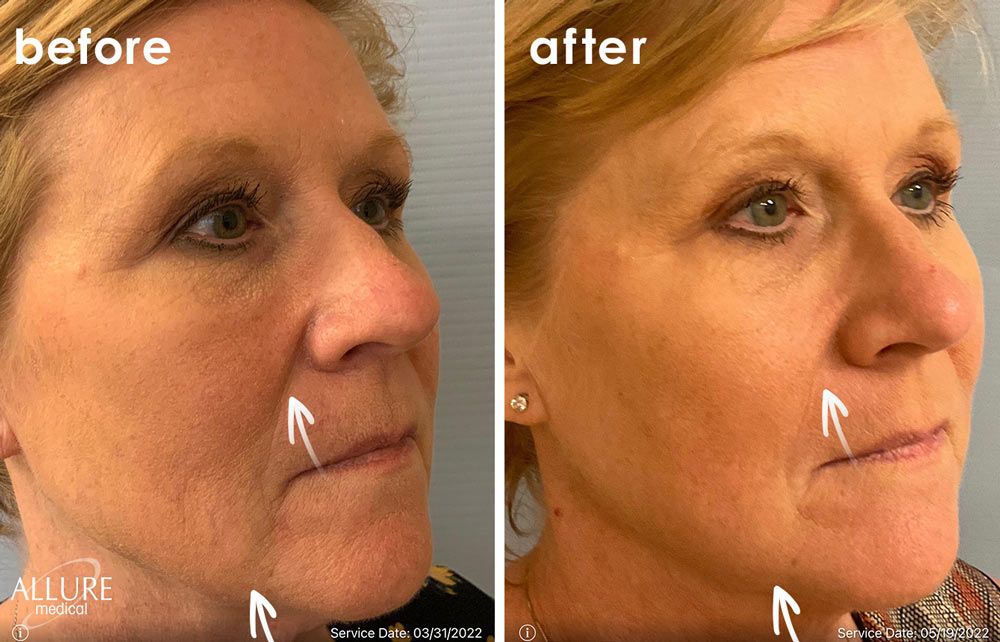 Before and After Thread Lift treatment #4