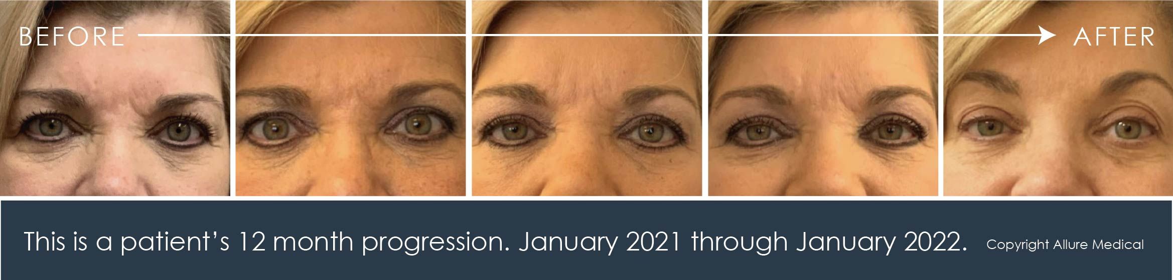 This is a 12 month progression of droopy eye treatment at Allure Medical