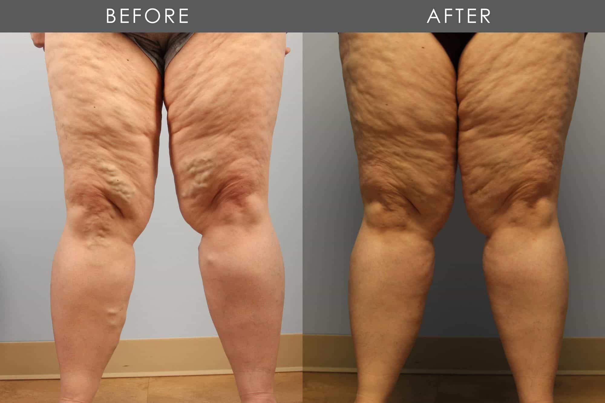 Before and After Varicose Vein Treatment treatment #2