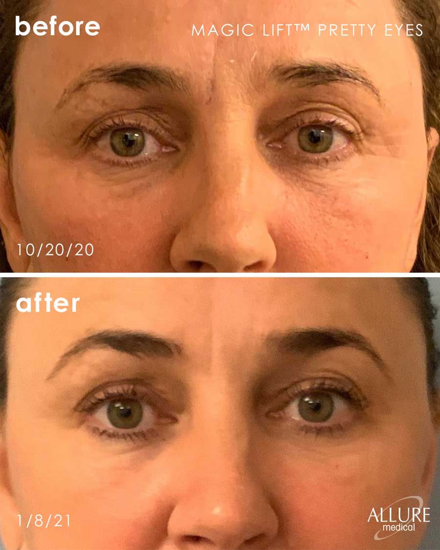 Before and After Magic Lift (Non-Surgical Face Lift) treatment #2