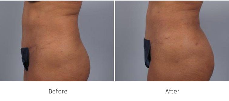 Brazilian Butt Lift Cosmetic Surgery | Allure Medical