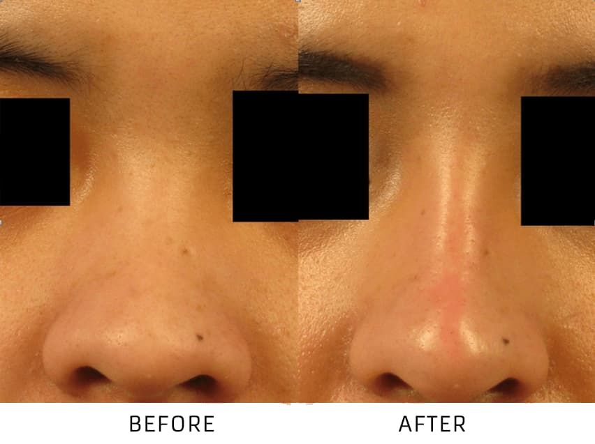 Before and After Non Surgical Nose Job treatment #1