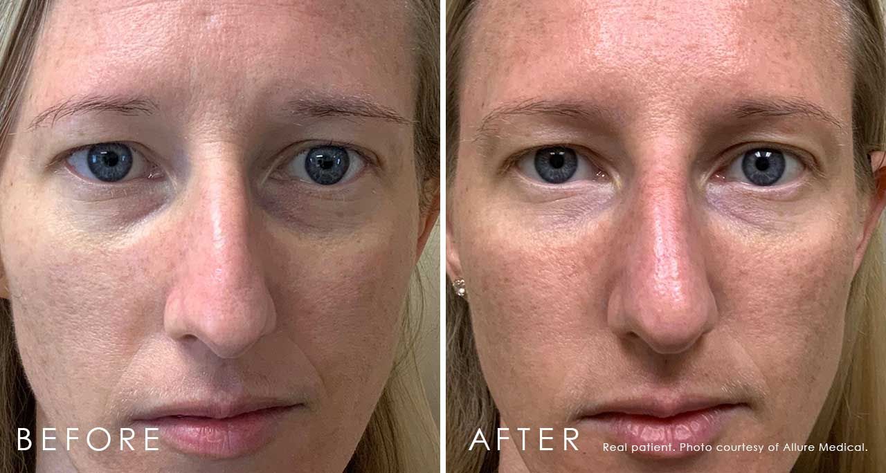 Before and After Xeomin® treatment #3