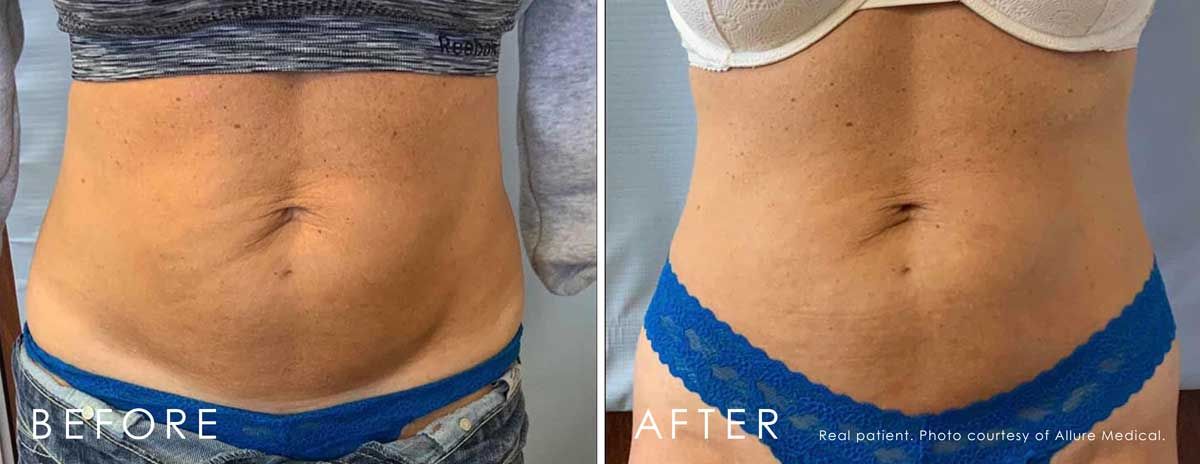 Before and After Lipodissolve treatment #2