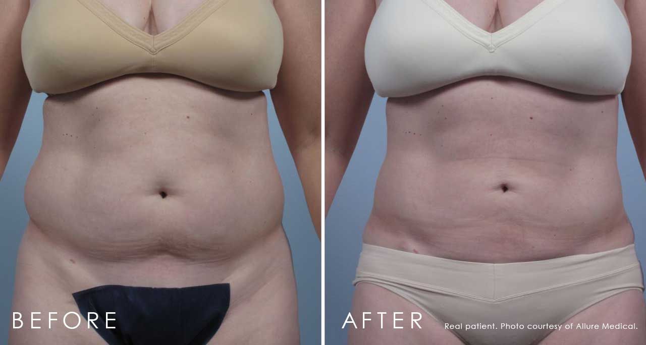 Before and After Liposuction treatment #2