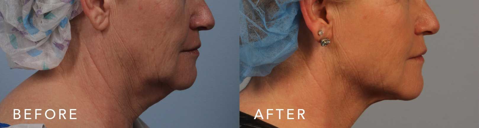 scarless neck lift surgery before and after
