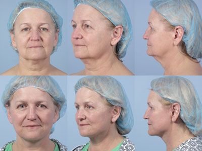 facelift before and afters