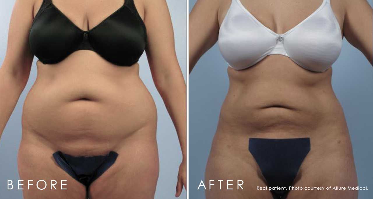 Before and After Liposuction treatment #4