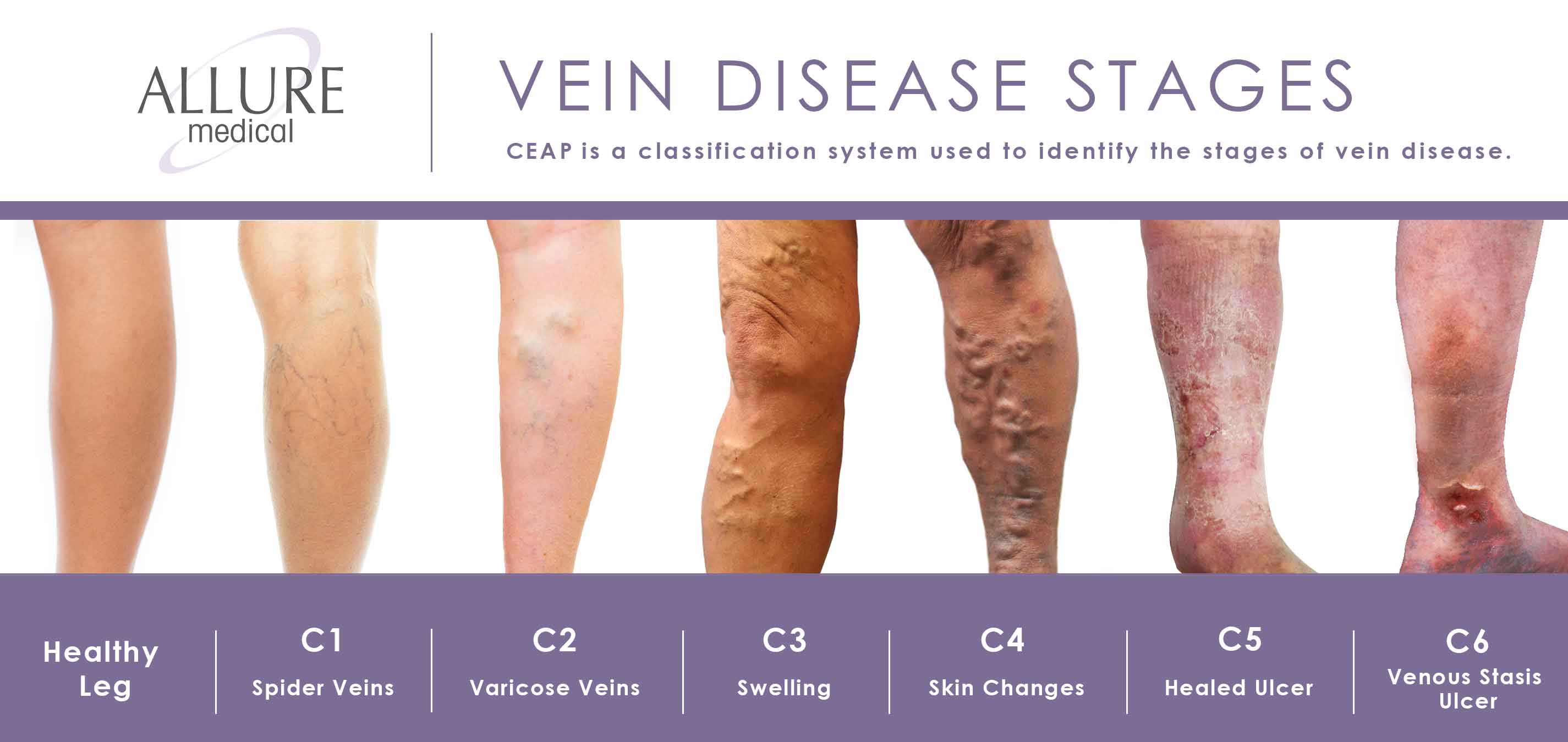chronic venous insufficiency vs venous stasis