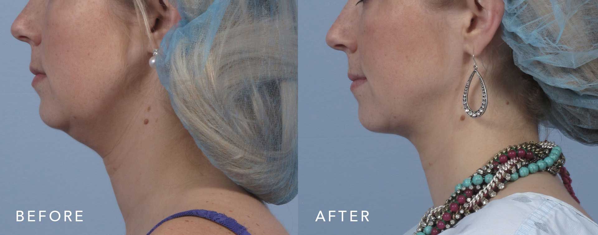 Before and After Scarless Neck Lift treatment #2