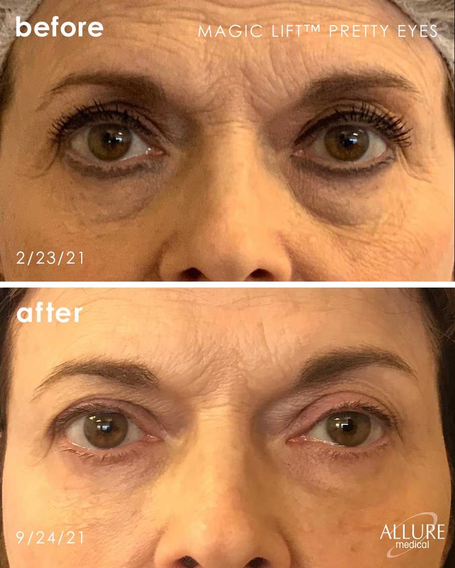 Before and After Magic Lift (Non-Surgical Face Lift) treatment #3