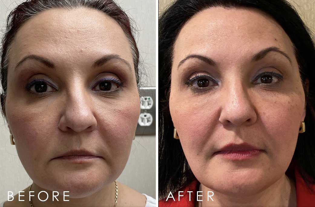 Before and After Xeomin® treatment #1