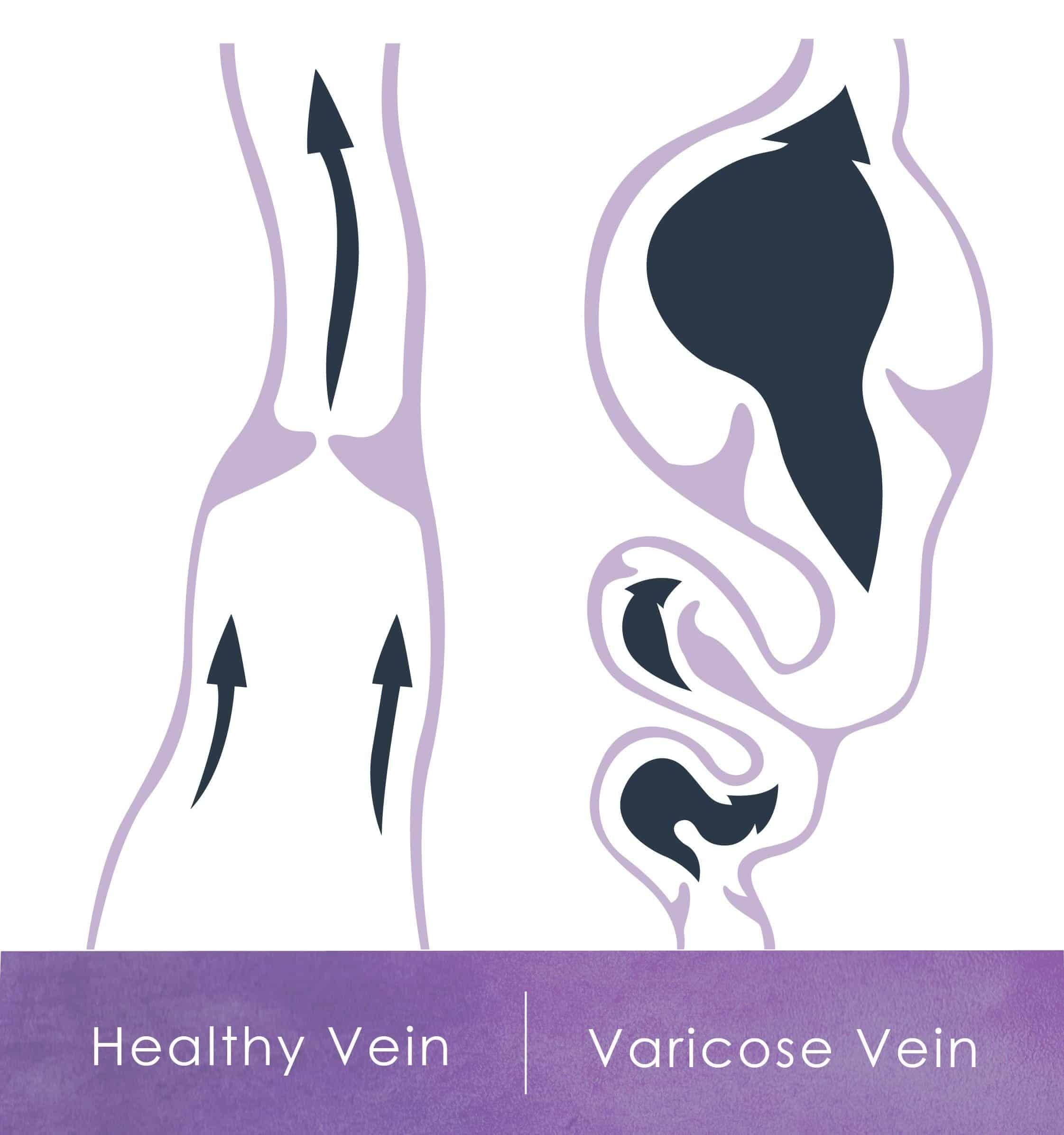 Diagram of healthy vs varicose vein