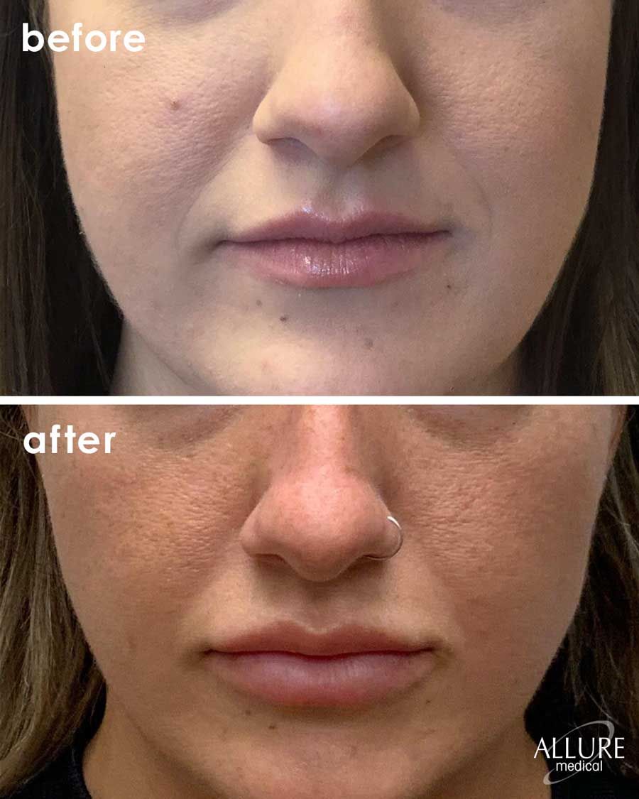Before and After Lip Filler treatment #1