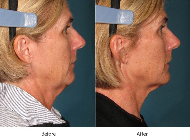 Before and After Ultherapy Skin Tightening Treatment treatment #2