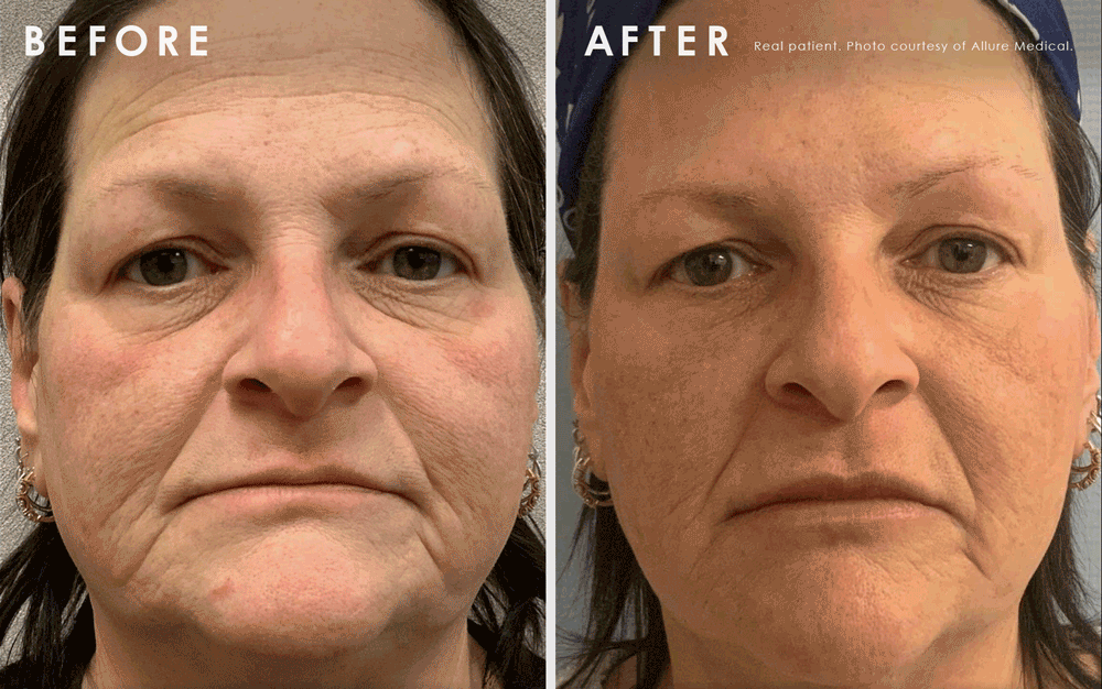 magic lift gif of a patient before and after from trapezoidal shaped face to an oval shaped face