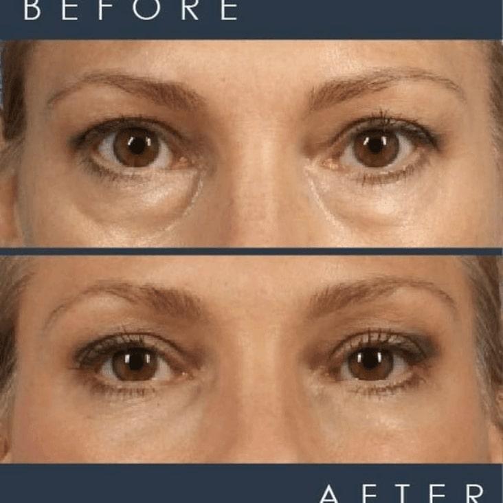 before and after photo of magic lift pretty eyes package