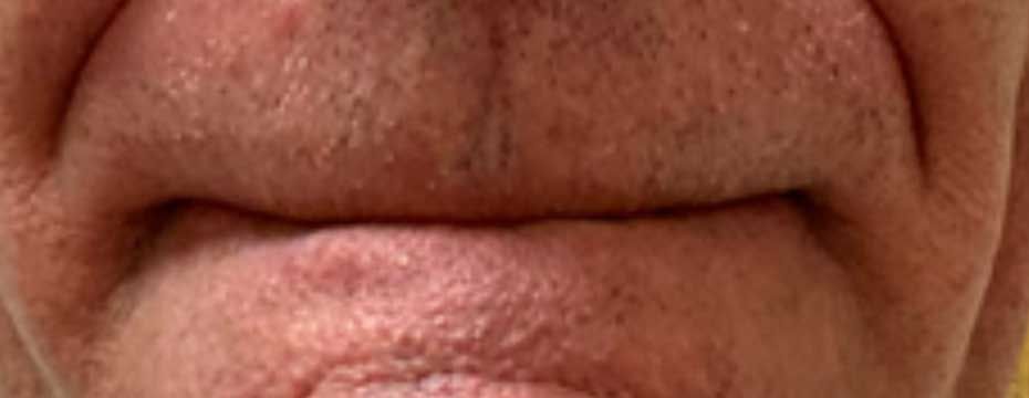 Lip fiber muscles causing the lips to disappear.