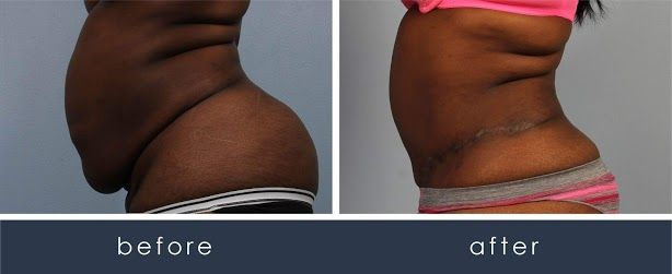 Before and After CombiTuck Procedure/Tummy Tuck  treatment #3