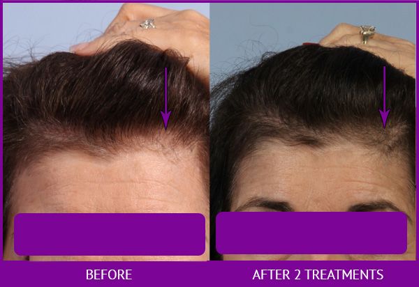 Before and After Platelet Rich Plasma (PRP) for Hair Restoration treatment #2