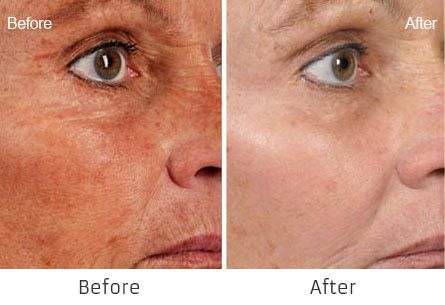 Before and After Fraxel Laser for Skin Resurfacing treatment #1