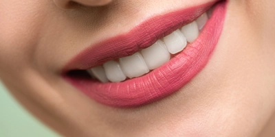 Teeth Whitening - Manor Dental Care Step 2 Composite Bonding