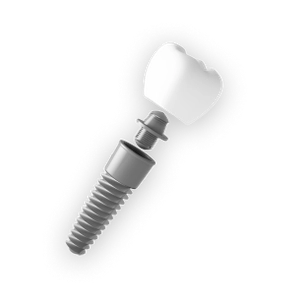 3D image of a single implant with screw and crown.