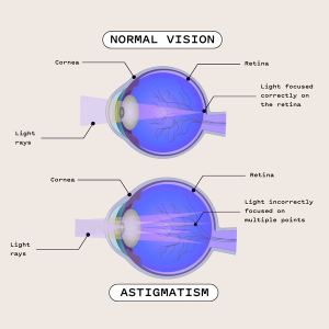 Astigmatism.png