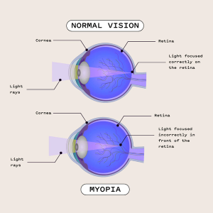 Myopia.png