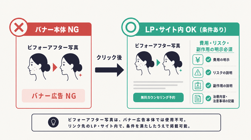 ビフォーアフター写真の掲載可否フロー（バナー本体はNG、リンク先LPは条件付きOK）
